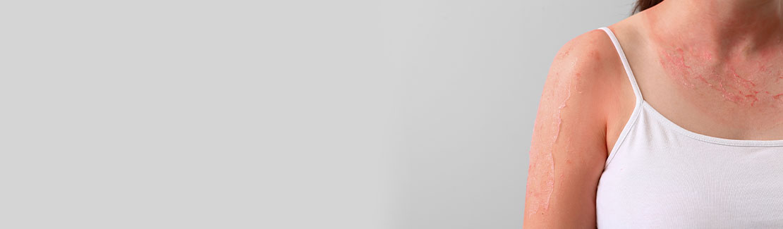 Hilfe bei Sonnenbrand