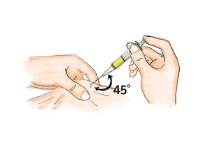 Abbildung zeigt, wie die Spritze der Misteltherapie zu setzen ist